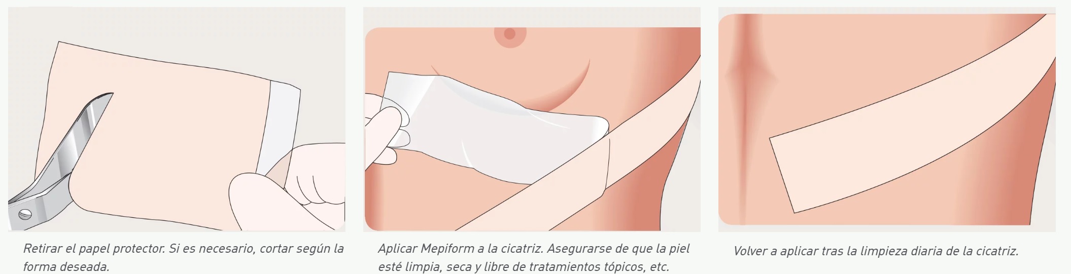 Mepiform instructions for use